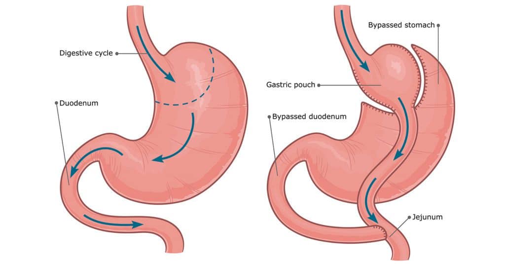 Stomach bypass graphic